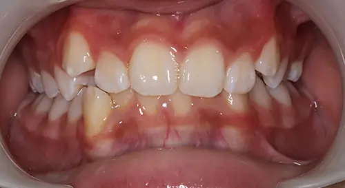 Crowding Patient 18 Before 2