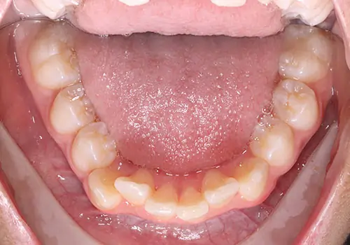 Crowding Patient 18 Before 3