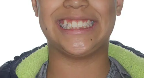 Crowding Patient 18 Before 1