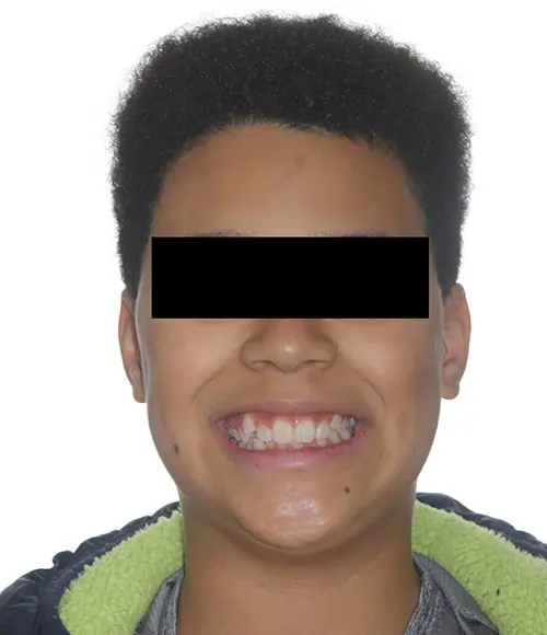 Crowding Patient 18 Before 1