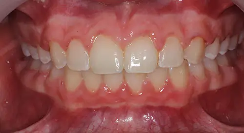 Spacing Patient 5 After 2