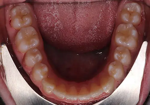 Spacing Patient 5 After 3