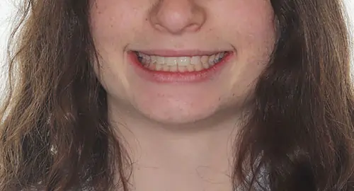 Spacing Patient 5 After 1