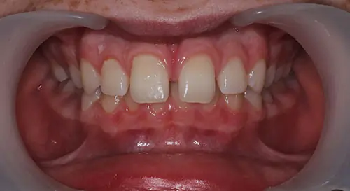 Spacing Patient 5 Before 2