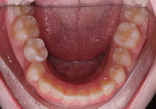 Spacing Patient 5 Before 3