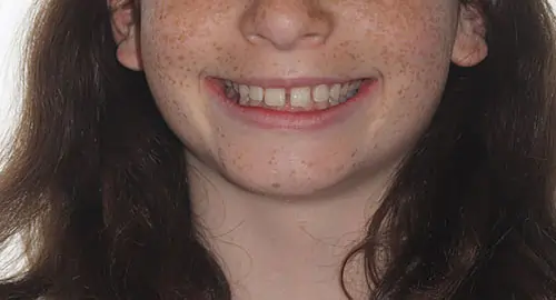 Spacing Patient 5 Before 1