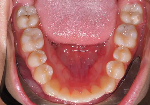 Spacing Patient 6 After 3