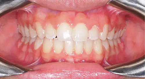 Spacing Patient 6 After 2