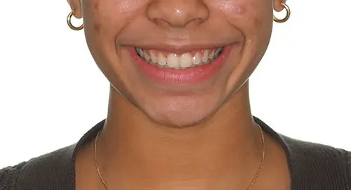 Spacing Patient 6 After 1