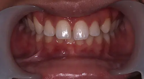 Spacing Patient 6 Before 2