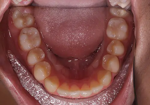 Spacing Patient 6 Before 3