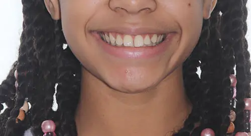 Spacing Patient 6 Before 1