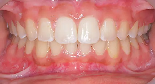 Crowding Patient 19 After 2