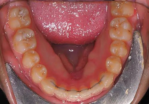 Crowding Patient 19 After 3
