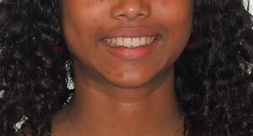 Crowding Patient 19 After 1