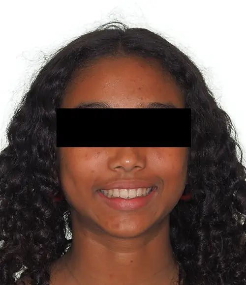 Crowding Patient 19 After 1