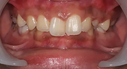 Crowding Patient 19 Before 2