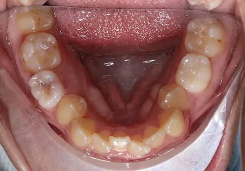 Crowding Patient 19 Before 3