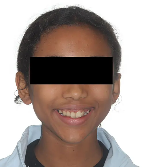 Crowding Patient 19 Before 1