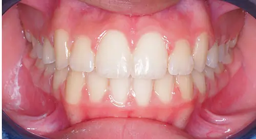 Crowding Patient 20 After 2