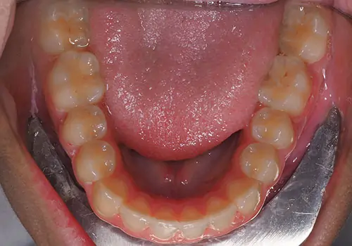 Crowding Patient 20 After 3