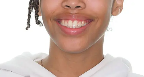 Crowding Patient 20 After 1