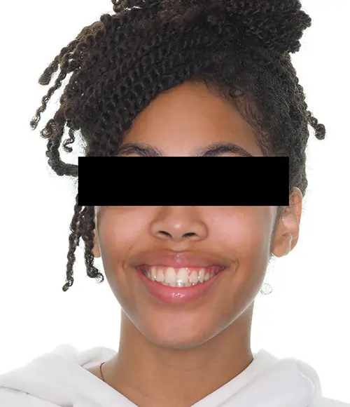 Crowding Patient 20 After 1