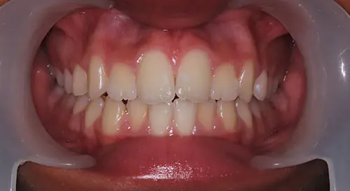 Crowding Patient 20 Before 2