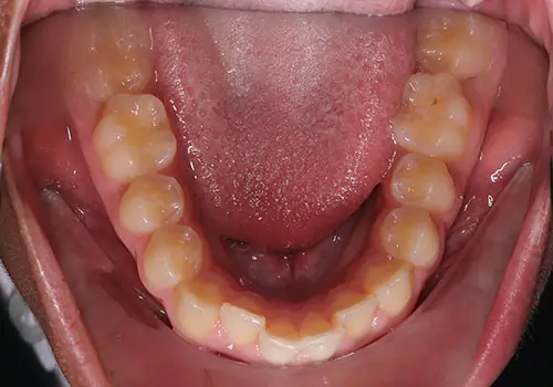 Crowding Patient 20 Before 3