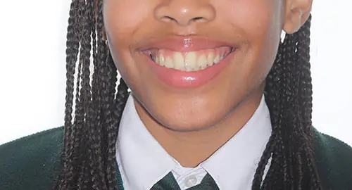 Crowding Patient 20 Before 1