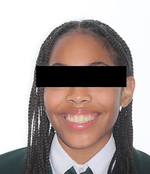 Crowding Patient 20 Before 1