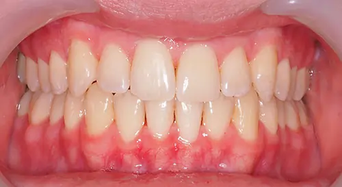 Crowding Patient 21 After 2