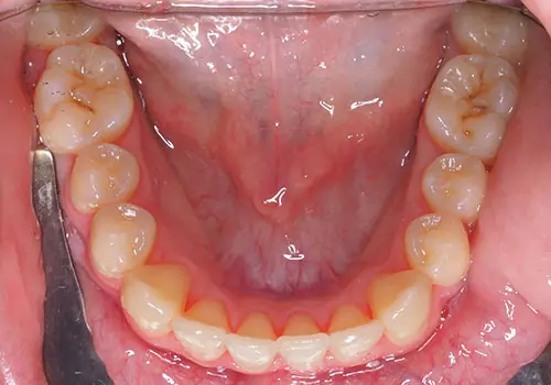 Crowding Patient 21 After 3