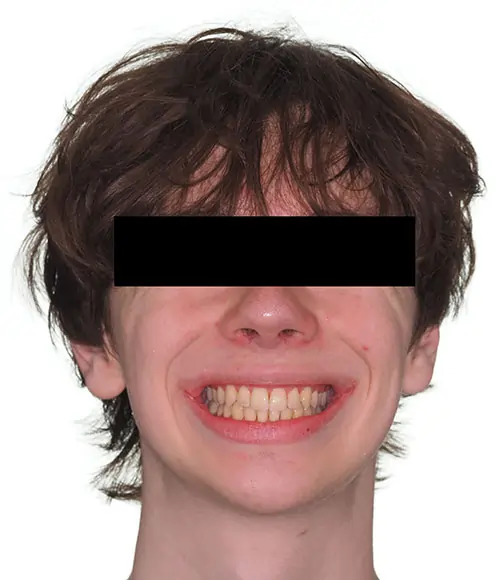 Crowding Patient 21 After 1