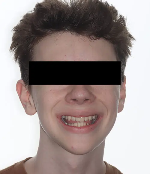 Crowding Patient 21 Before 1