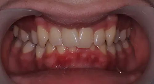 Crowding Patient 21 Before 2