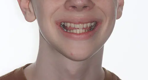 Crowding Patient 21 Before 1