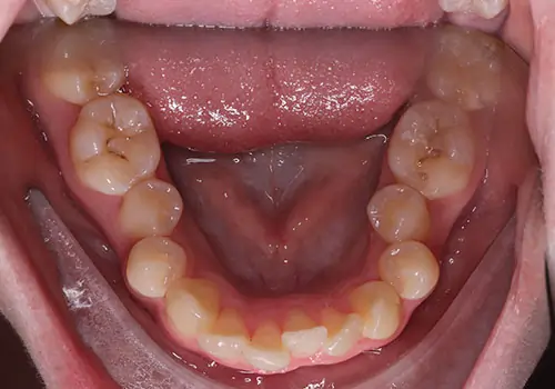 Crowding Patient 21 Before 3
