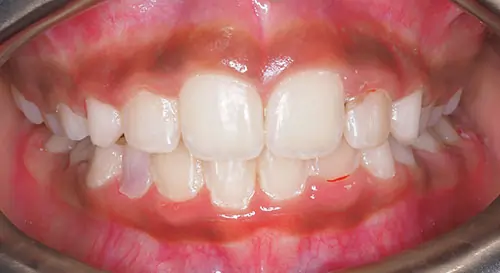 Phase 1 Patient 14 After 2