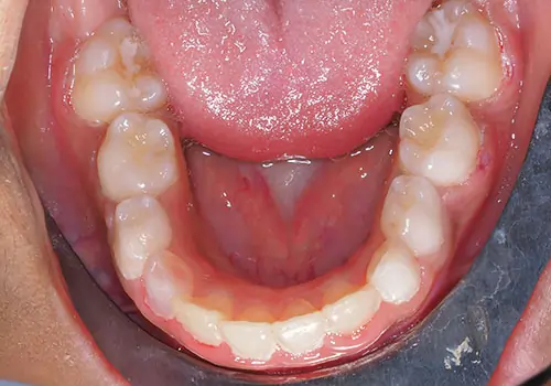 Phase 1 Patient 14 After 3