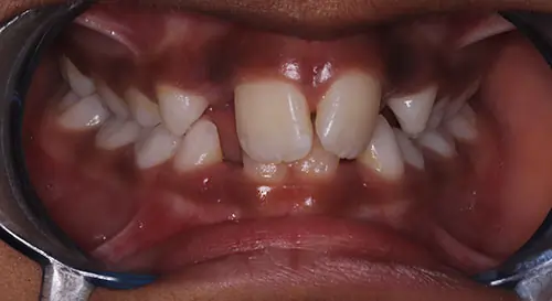 Phase 1 Patient 14 Before 2