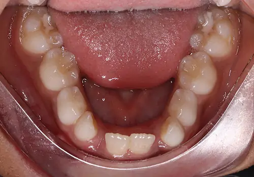 Phase 1 Patient 14 Before 3