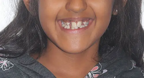 Phase 1 Patient 14 Before 1