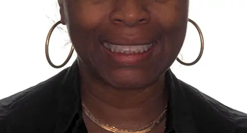 Invisalign Patient 9 After 1