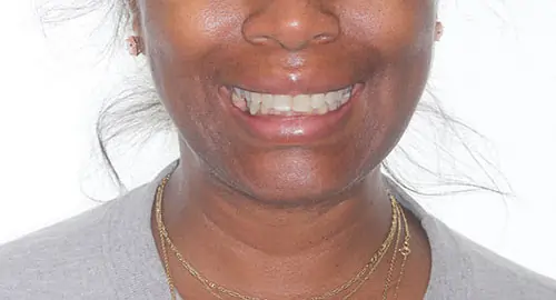 Invisalign Patient 9 Before 1