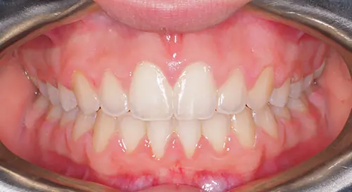 Overbite Patient 11 After 2