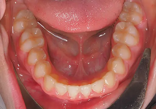 Overbite Patient 11 After 3