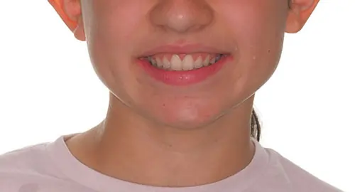 Overbite Patient 11 After 1