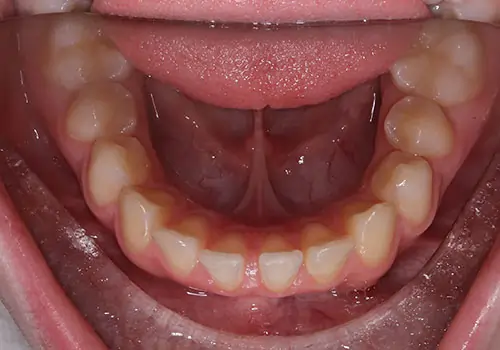 Overbite Patient 11 Before 3