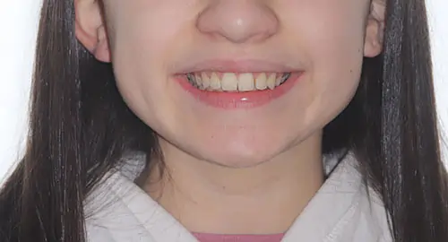 Overbite Patient 11 Before 1